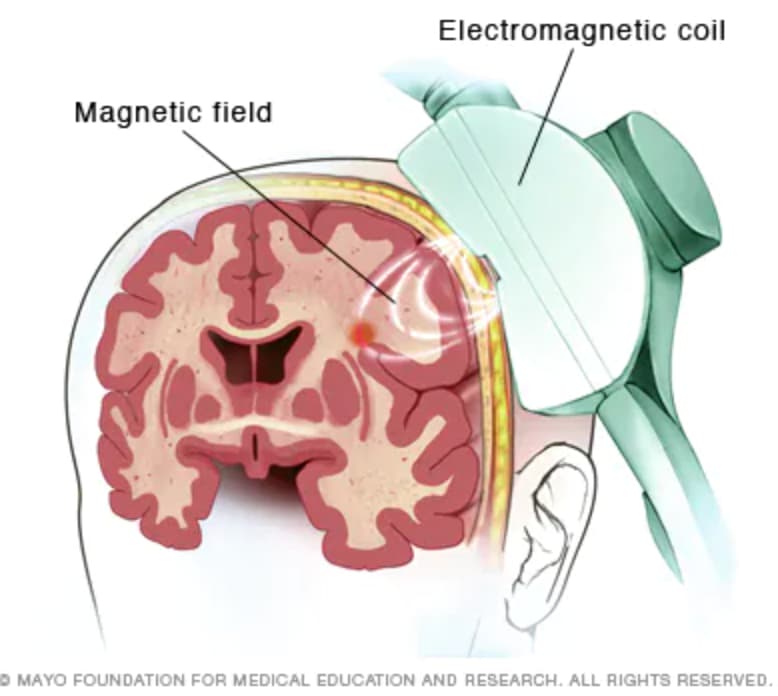 tms coil placement - Magnetic field Electromagnetic coil Mayo Foundation For Medical Education And Research. All Rights Reserved.